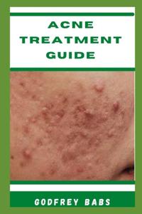 Acne Treatment Guide
