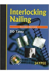 Interlocking Nailing