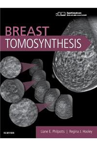 Breast Tomosynthesis