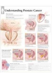 Understanding Prostate Cancer Wall Chart