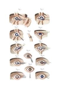 Cataract and Artificial Pupil