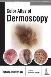 Color Atlas of Dermoscopy