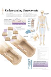 Understanding Osteoporosis Chart