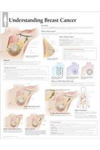 Understanding Breast Cancer Wall Chart