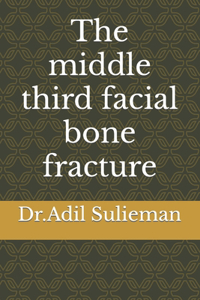 middle third facial bone fracture