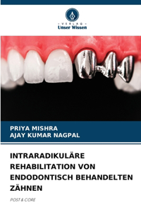 Intraradikuläre Rehabilitation Von Endodontisch Behandelten Zähnen