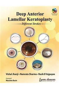 Deep Anterior Lamellar Keratoplasty Different Strokes