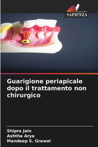Guarigione periapicale dopo il trattamento non chirurgico