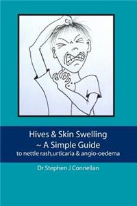 Hives & Skin Swelling A Simple Guide