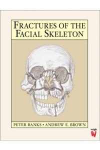 Fractures of the Facial Skeleton