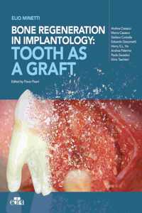 Bone regeneration in implantology - tooth as a graft