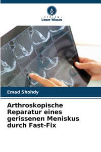 Arthroskopische Reparatur eines gerissenen Meniskus durch Fast-Fix