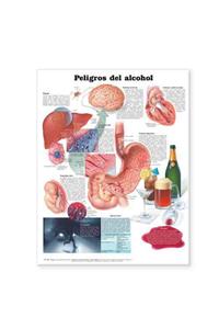 Dangers of Alcohol Anatomical Chart in Spanish (Peligros del alcohol)