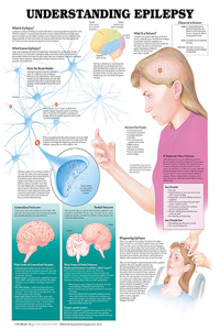 Understanding Epilepsy Anatomical Chart