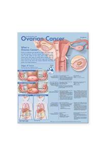Understanding Ovarian Cancer Anatomical Chart