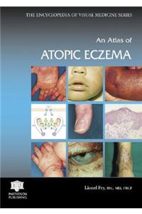 An Atlas of Atopic Eczema