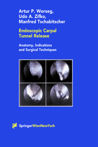 Endoscopic Carpal Tunnel Release