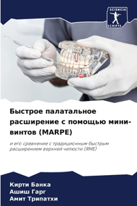 Быстрое палатальное расширение с помощью