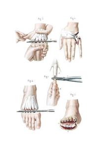 Amputations in the Continuity of the Bones Notebook