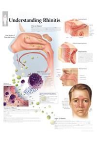 Understanding Rhinitis Laminated Poster