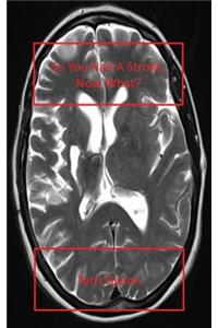 So You Had a Stroke