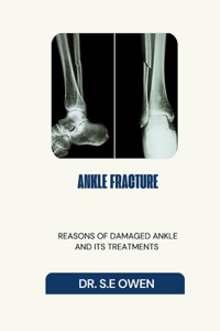 Ankle Fracture: Reasons of Damaged Ankle and Its Treatments