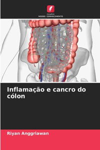 Inflamação e cancro do cólon