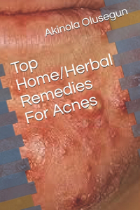 Top Home/Herbal Remedies For Acne