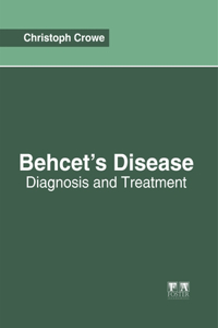 Behcet's Disease: Diagnosis and Treatment