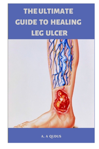 The Ultimate Guide to Healing Leg Ulcer
