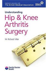 Understanding Hip & Knee Arthritis Surgery