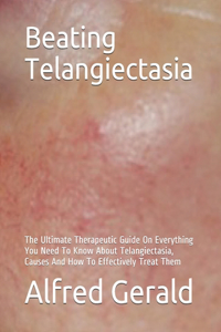 Beating Telangiectasia