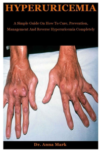 Hyperuricemia