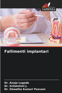 Fallimenti implantari