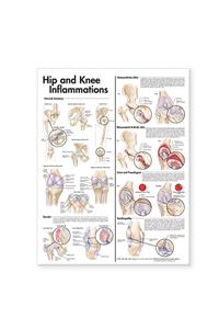 Hip and Knee Inflammations Anatomical Chart