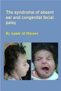 syndrome of absent ear and congenital facial palsy