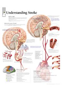 Understanding Stroke Chart: Laminated Wall Chart