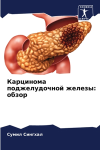 Карцинома поджелудочной железы