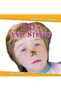 Bites and Stings