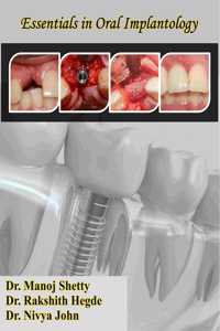 Essentials in Oral Implantology