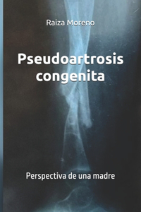Pseudoartrosis congenita