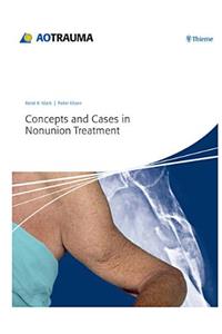 Concepts and Cases in Nonunion Treatment