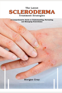 Latest Scleroderma Treatment Strategies