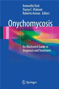 Onychomycosis