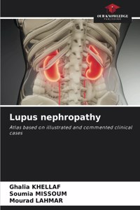 Lupus nephropathy