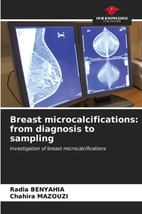 Breast microcalcifications
