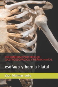 Enfermedad Por Reflujo Gastroesofágico Y Hernia Hiatal