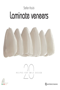 Laminate Veneers