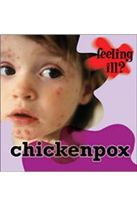 Chicken Pox