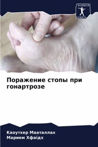 Поражение стопы при гонартрозе